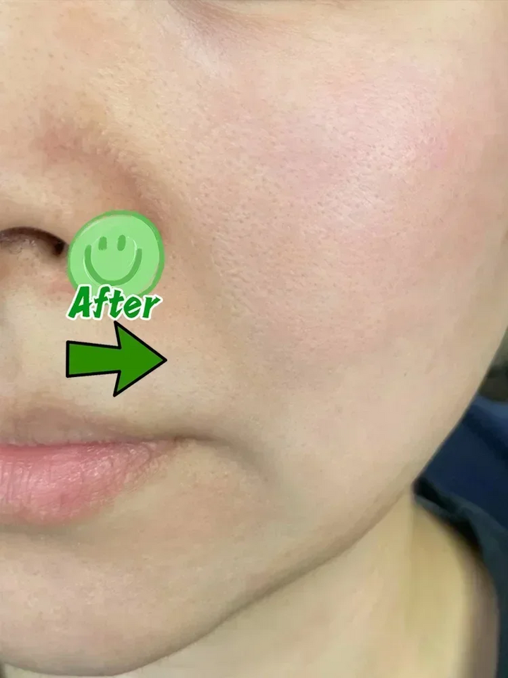 Anti-acne mark pothole Repair Men's Hole Repair Cream Fade to remove acne mark scar fade fill regeneration gel