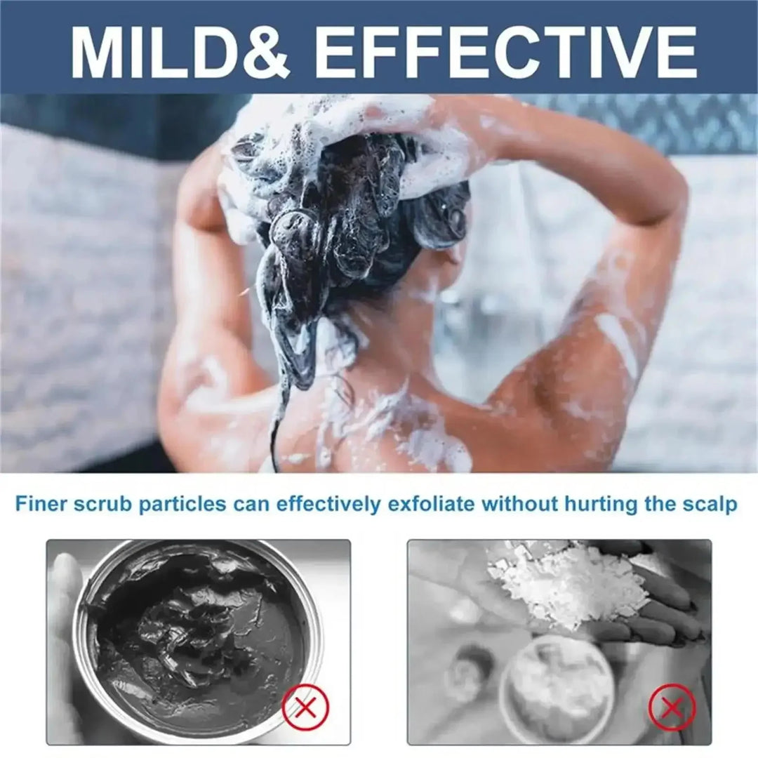 Fast Anti Exfoliating Scrub Remove Dandruff Anti Itching Treatment Seborrheic Scalp Oil Control Repair Scalp Beauty Health Care