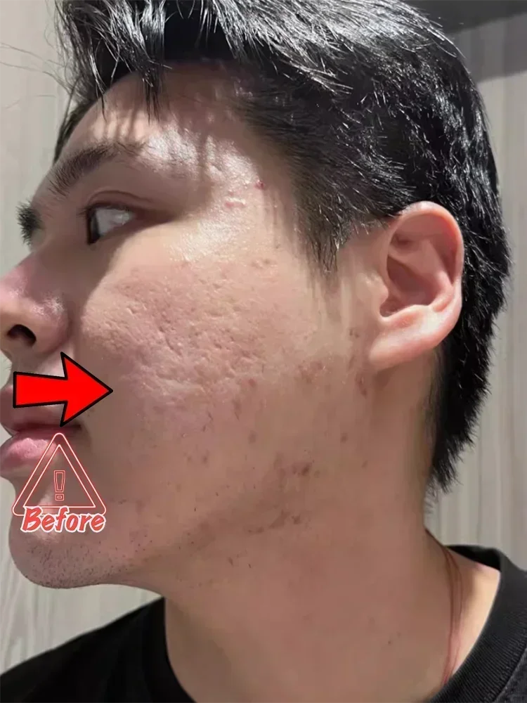 Anti-acne mark pothole Repair Men's Hole Repair Cream Fade to remove acne mark scar fade fill regeneration gel