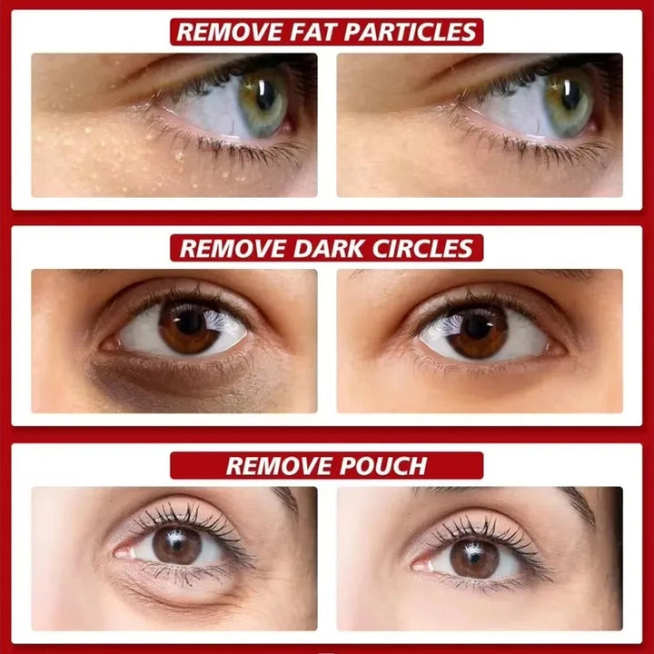 Fat Granules Removal Eye Serum Eye Milia Repair Treatment Products Wrinkle Lifting Moisturizing Anti-Puffiness Korean Skin Care