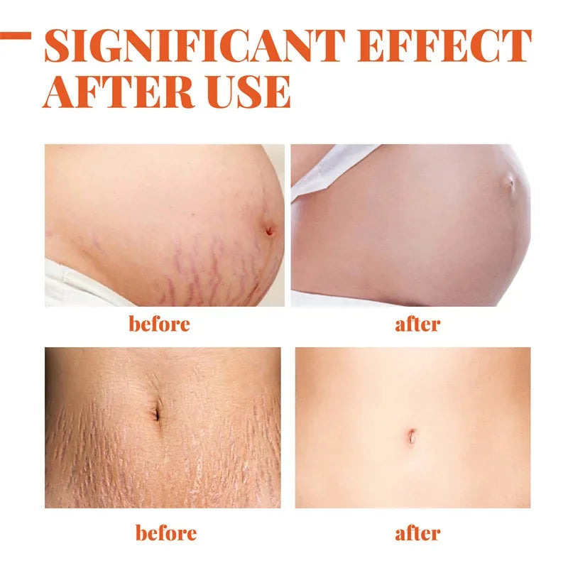 Removes Stretch Mark Cream Postpartum Repair Fade Stretch Marks Prevent Obesity Lifting Firming Moisturizing Brighten Skin Care