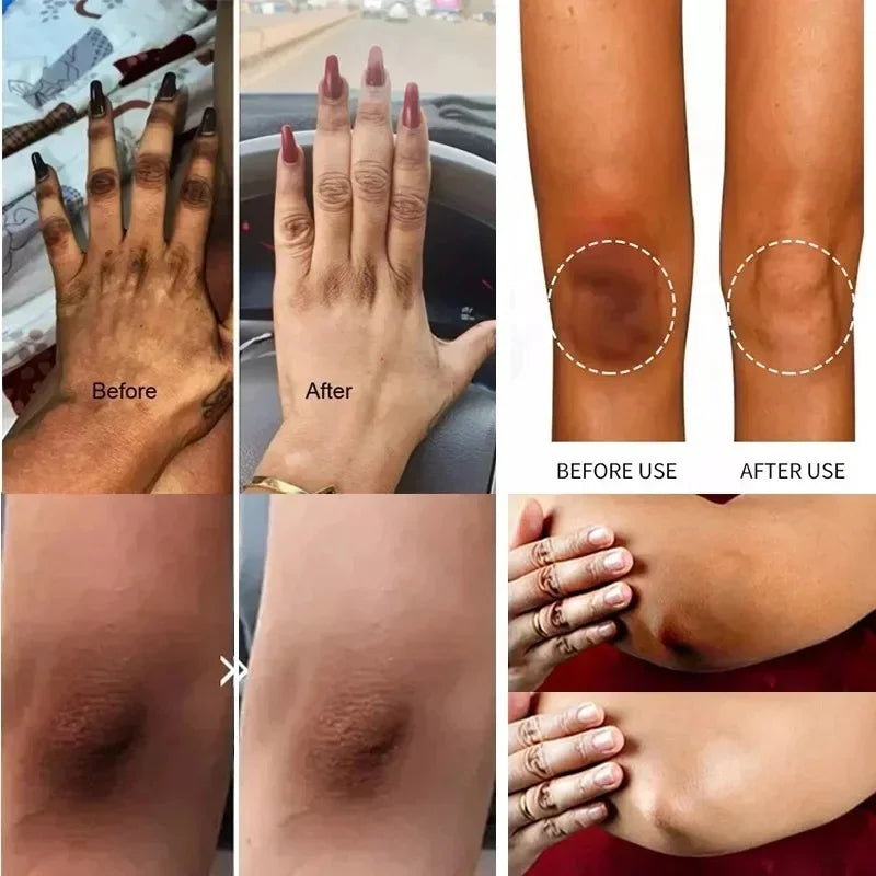 Body Whitening Lotion Dark Spot Remover For Underarms Knees Elbows Melanin Bleaching Lightening Skin Moisturizing Cream