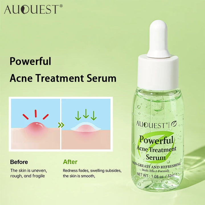 AUQUEST Salicylic Acid Acne Treatment Face Serum Oil Control Herbal Fades Acne Marks Pimple Remover Facial Skin Care