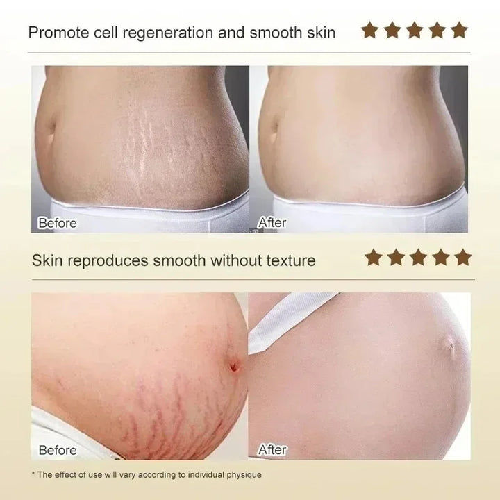 Cream For Pregnancy Stretch Marks Removal Eliminate Red White Old Stretch Marks  2025