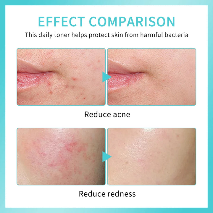 Hypochlorous Acid Spray Toner for Face Helps Reduce Redness Breakouts Soothing pH Balancing Toner Skincare