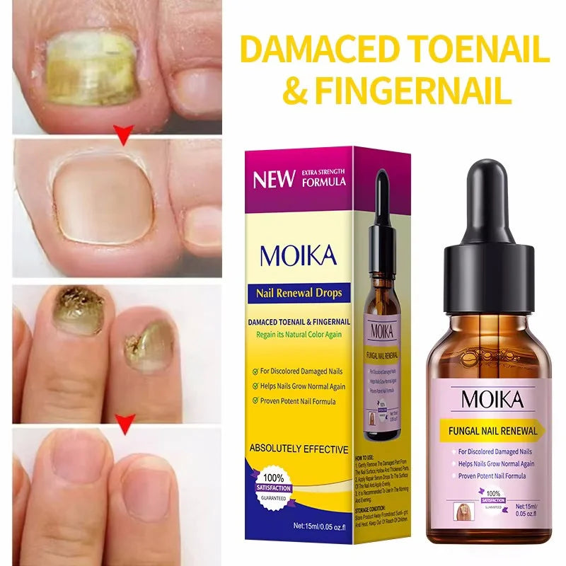 Fungal Nail Treatment Serum Foot Nail Fungus Removal Repair Gel Anti Infection Paronychia Onychomycosis Foot Nails Care Essence