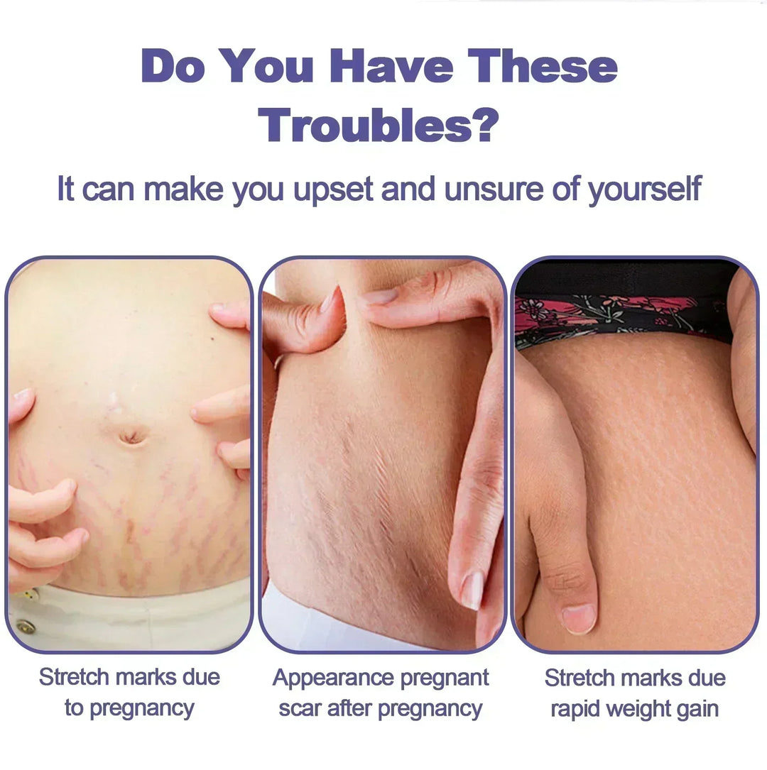 Stretch Mark Removal Cream Permanently Removes Stretch Marks Rejuvenates Skin Stretch Mark Removal Cream