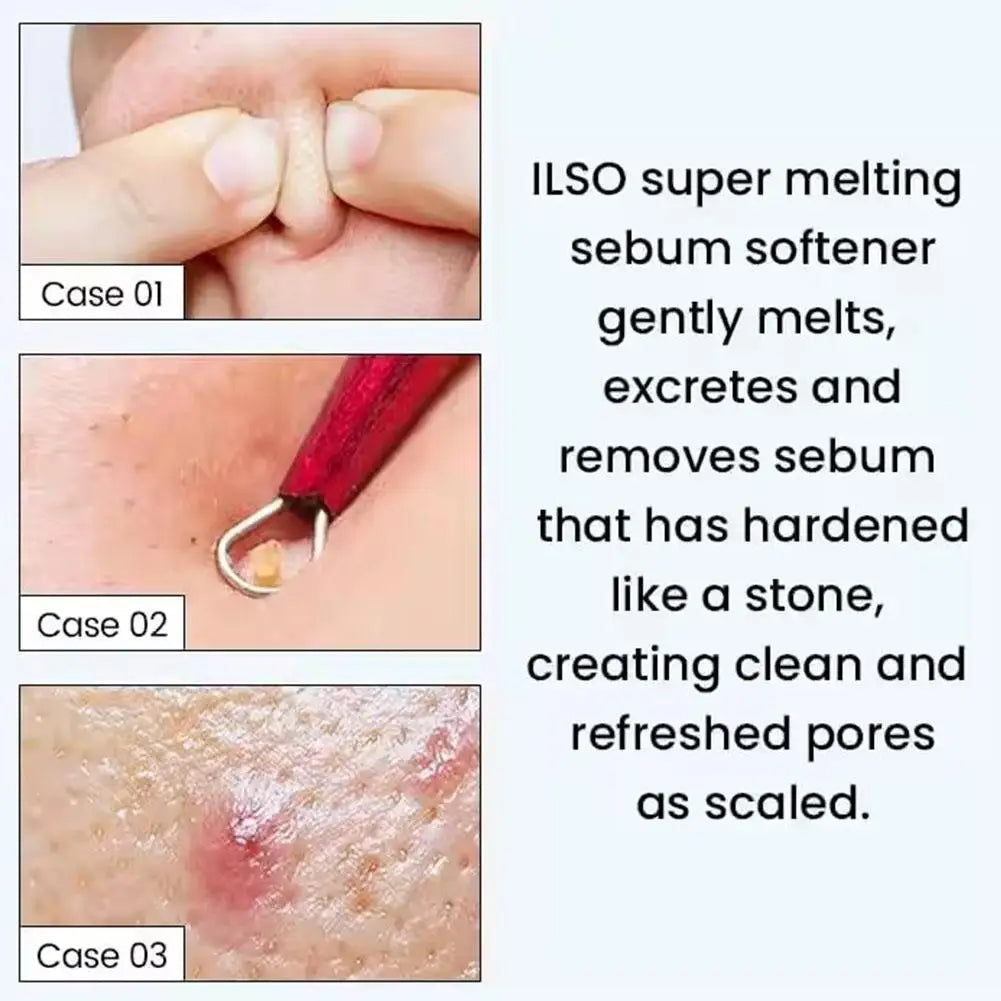 150ML ilso Blackhead Removal Toner - Korean Sebum Softener Deep Cleansing Oil Control Moisturizing Facial Care