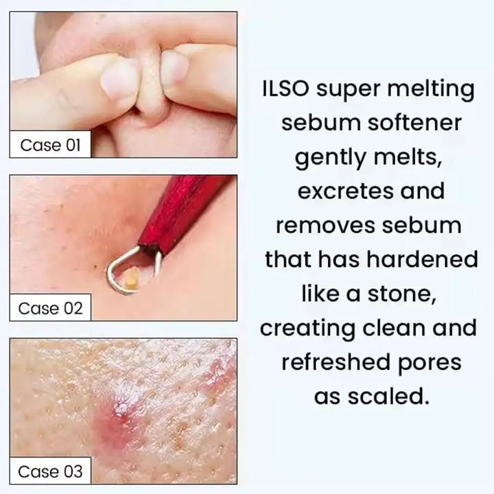 150ML ilso Blackhead Removal Toner - Korean Sebum Softener Deep Cleansing Oil Control Moisturizing Facial Care