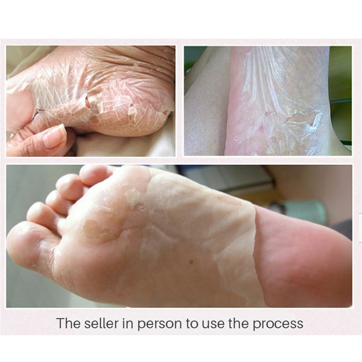 Exfoliating Foot Peel Mask Exfoliating Peel Renewal Foot Mask Soft Remove Dead Skin Pedicure Detox Pads Foot Spa Peel 3ml