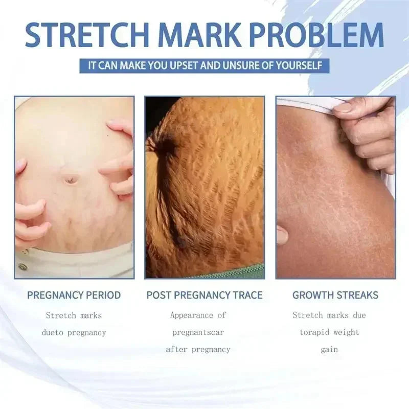Stretch Marks Removal Cream Light Lines Postpartum Obesity Pregnancy Powerful Fast Absorption