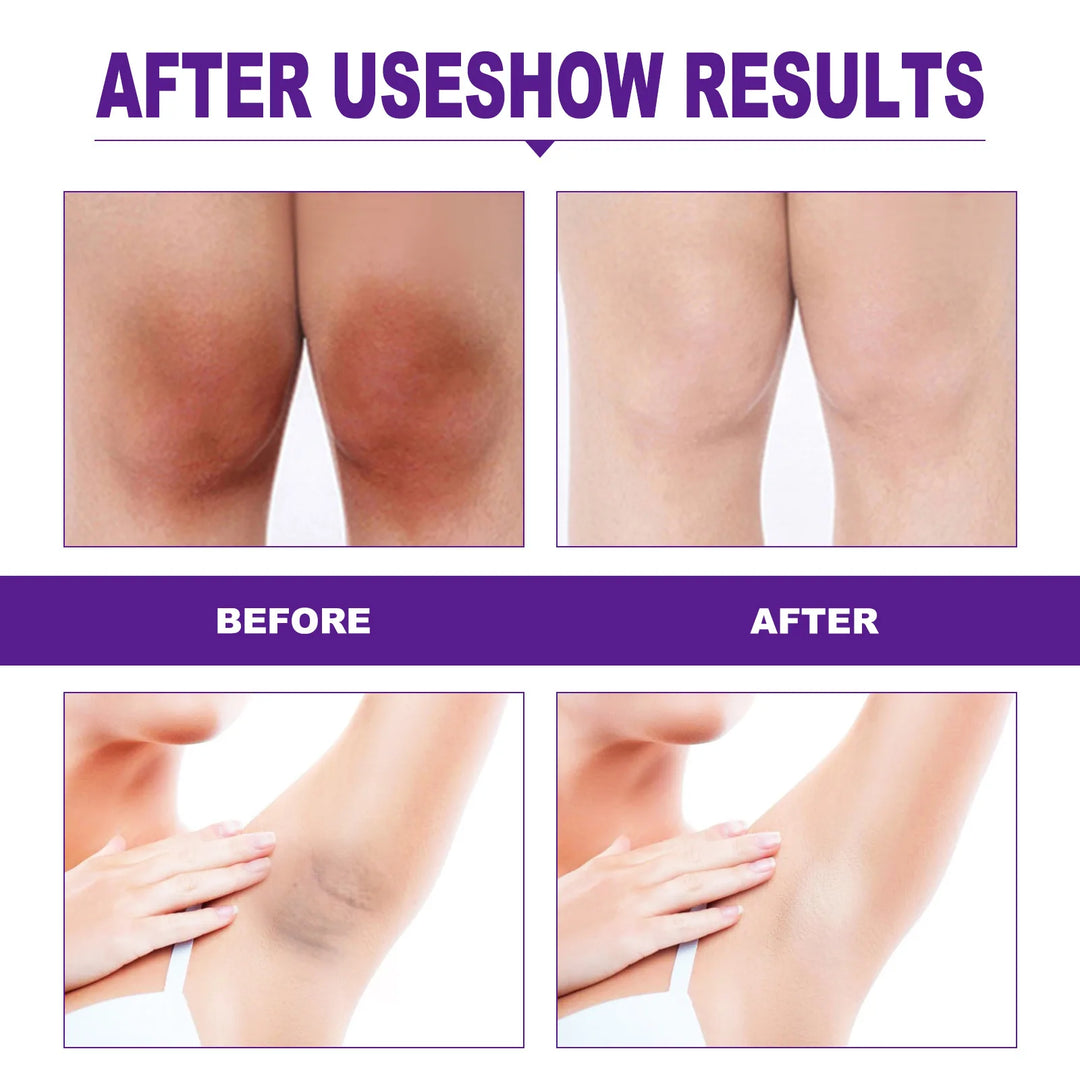 Body Whitening Cream Brightening Intimate Area Underarm Butt Inner Thigh Bleaching Remove Melanin Private Parts Whitening Cream