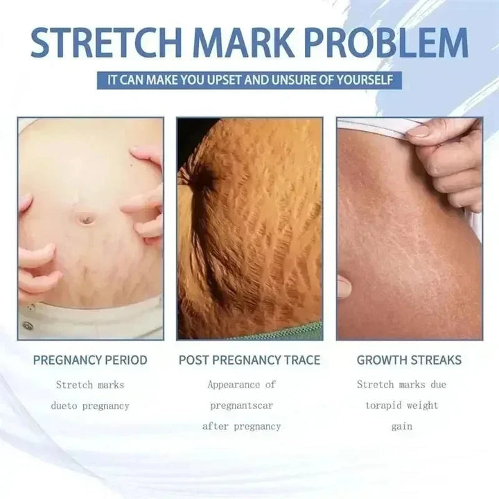 Cream For Pregnancy Stretch Marks Removal Eliminate Red White Old Stretch Marks  2025