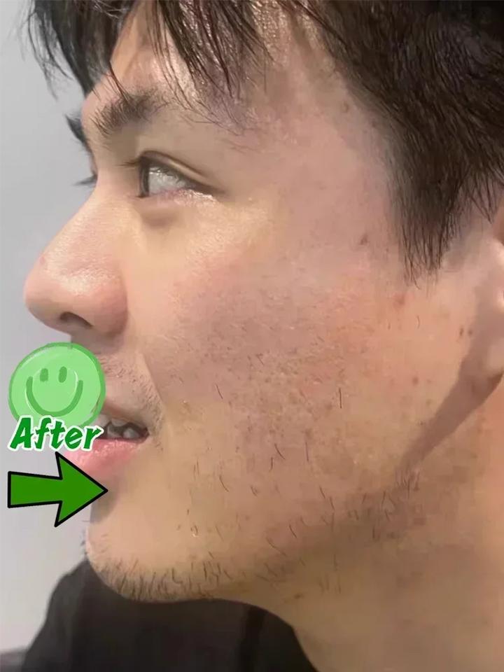 Anti-acne mark pothole Repair Men's Hole Repair Cream Fade to remove acne mark scar fade fill regeneration gel