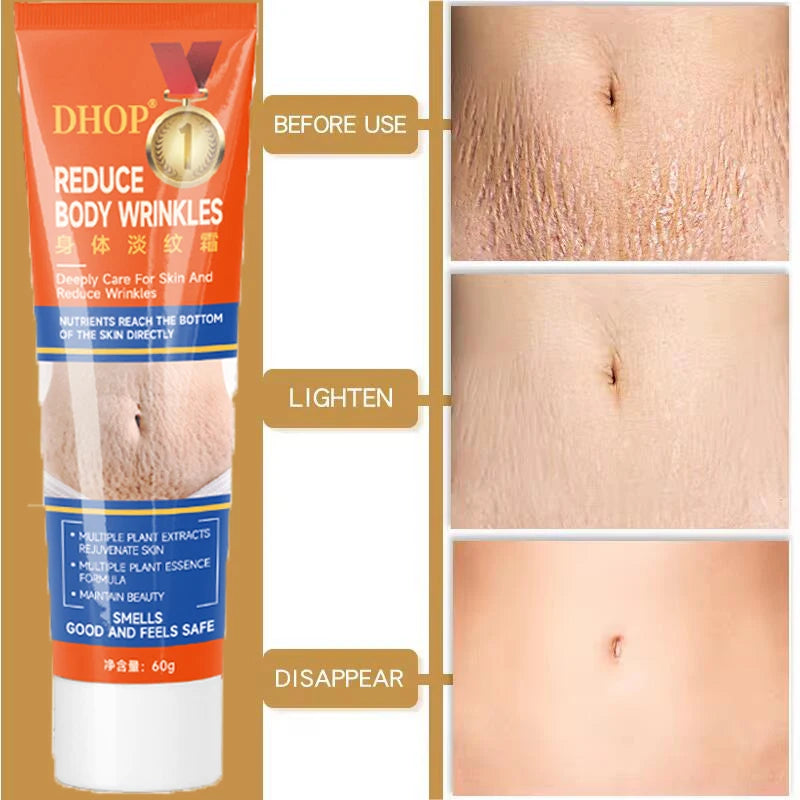 Stretch Marks Permanent Removal Cream Maternity Pregnant Women Pregnancy Anti-Winkle Smooth Repair Firming Skin Body Skin Care
